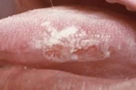 Лейкоплакия Лейкоплакия