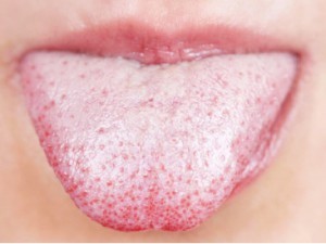 Язык обложенный белым налетом Язык обложенный белым налетом