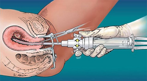 zamershaya-beremennost operasia Замершая беременность
