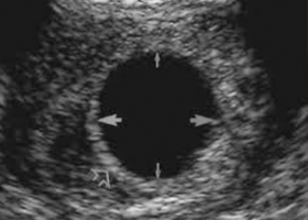 zamershaya-beremennost yaiso Замершая беременность