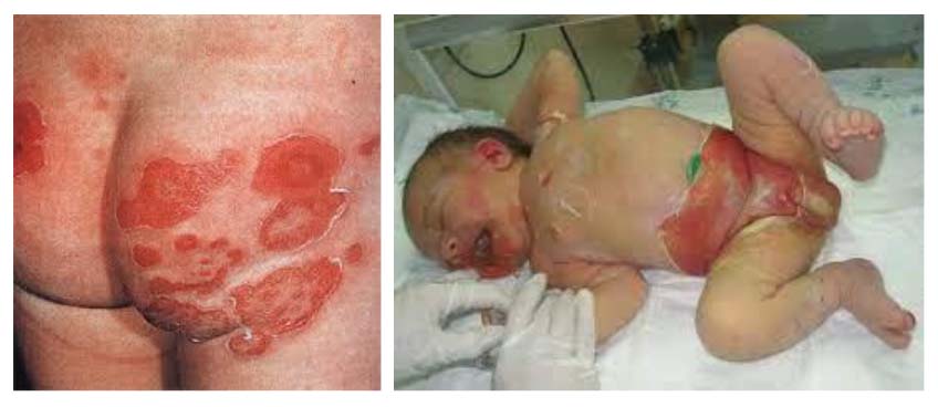 zolotistyj-stafilokokk 1 Золотистый стафилококк