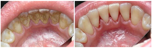 Зубной камень Зубной камень