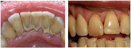 Зубной камень Зубной камень