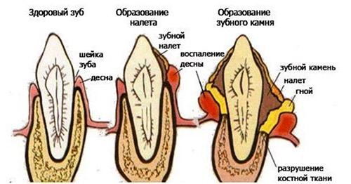 Зубной камень Зубной камень