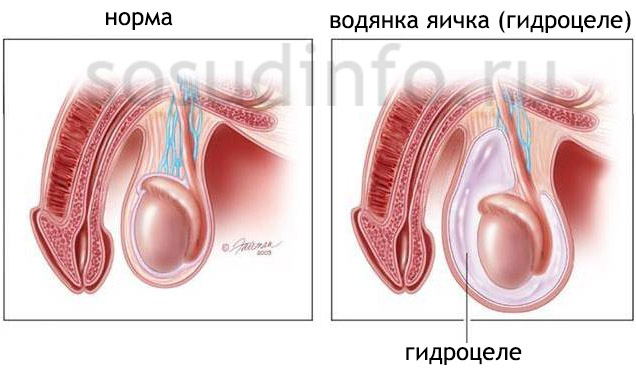 Гидроцеле - послеоперационне осложнение варикоцеле