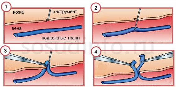 Традиционная флебэктомия крючком