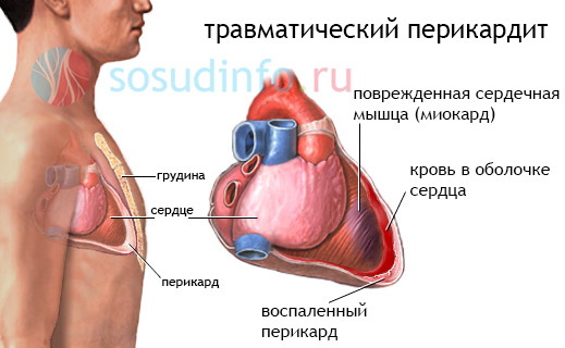 травматический перикардит