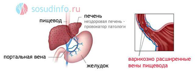 варикозное расширение вен пищевода