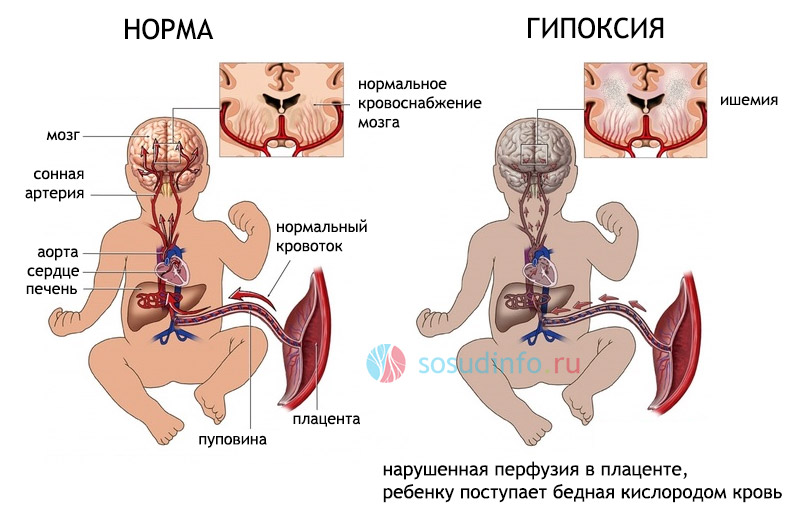 гипоксия головного мозга у плода