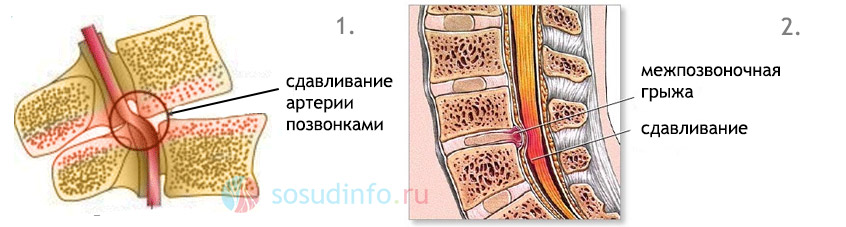 возможные причины экстравазальной компрессии ПА