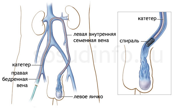 эмболизация при варикоцеле