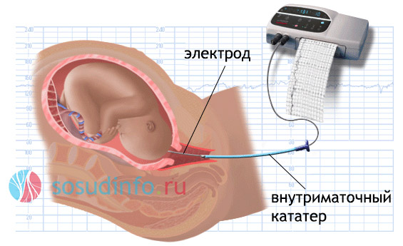 ЭКГ для диагностики состояния плода, подверженного гипоксии