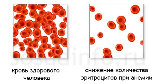 анемия - малокровие