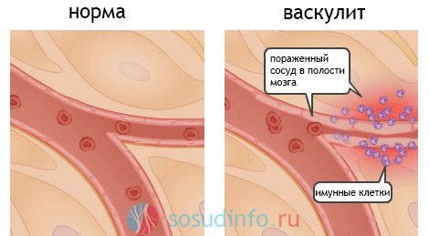 Имунные клетки ошибочно атакуют стенки сосуда при васкулите