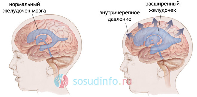 гидроцефалия гидроцефалия