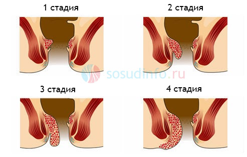 стадии геморроя