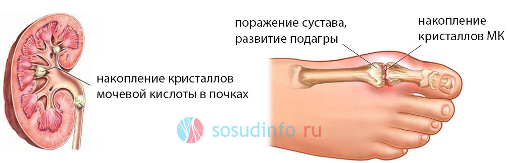 варианты поражения мочевой кислотой почек и суставов