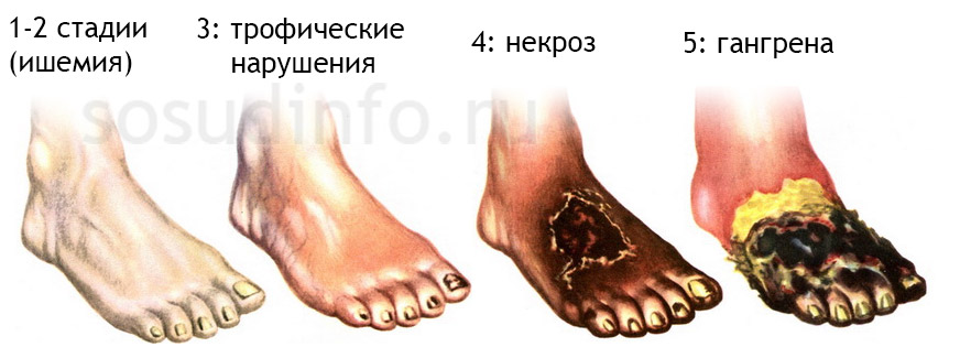 типичное развитие гангрены из-за сосудистых нарушений типичное развитие гангрены из-за сосудистых нарушений
