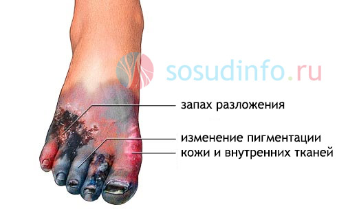 типичные признаки гангрены типичные признаки гангрены
