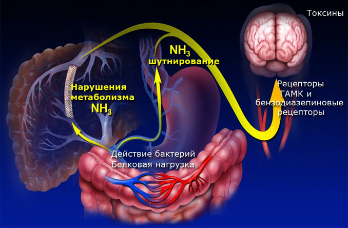 патогенез печеночной энцефалопатии