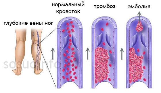 тромбоз и эмболия (отрыв тромба) на примере вен ног
