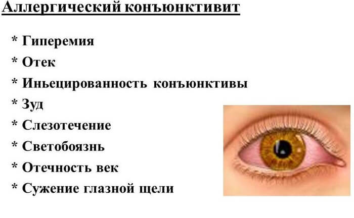 Аллергический конъюнктивит