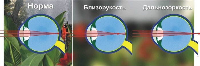 Близорукость и дальнозоркость