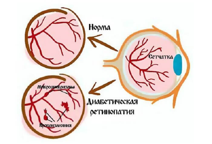 Диабетическая ретинопатия глаза