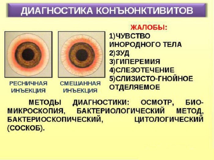 Диагностика конъюнктивитов