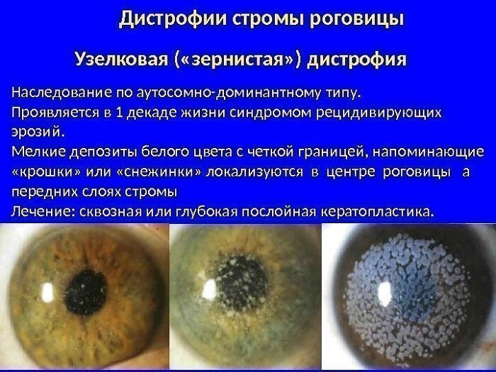 Дистрофические процессы в роговице