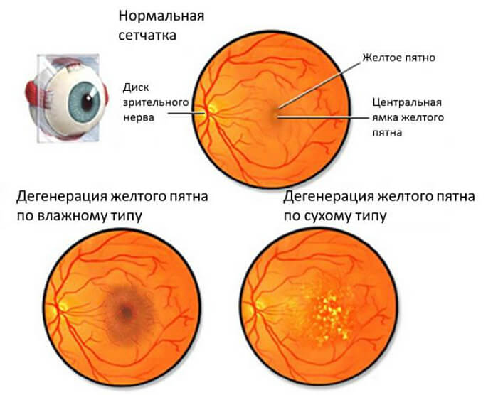 Дистрофия глазной сетчатки