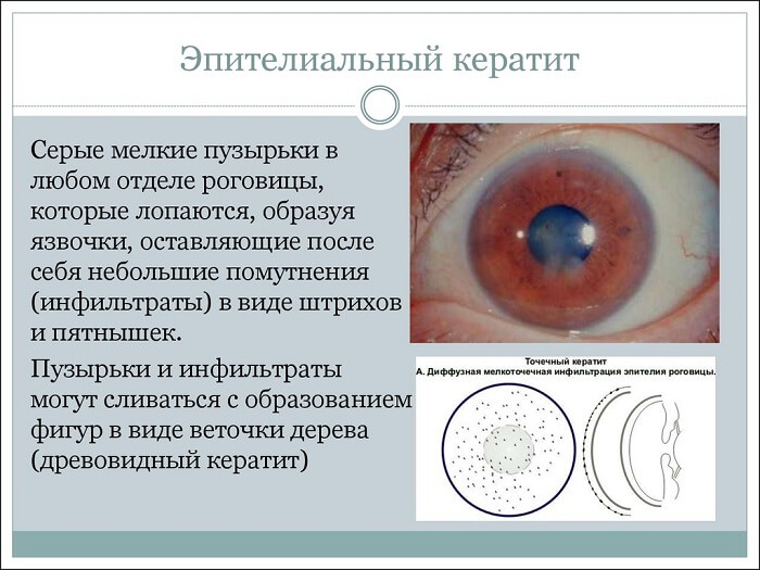 Эпителиальный кератит глаза