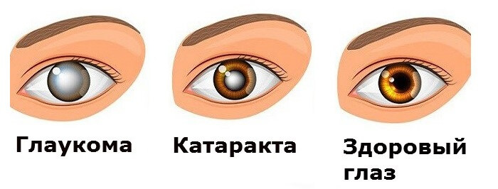 Глаукома и катаракта