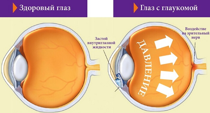 Глаукомо-циклитический криз