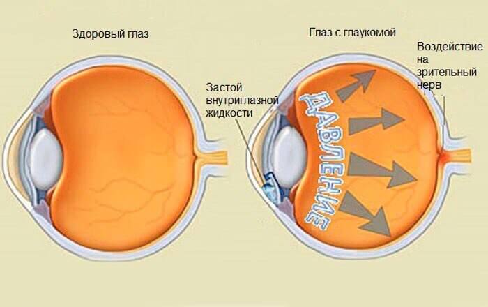 Глаз с глаукомой