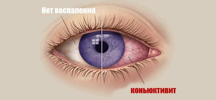 Глаз с воспалением конъюнктивы