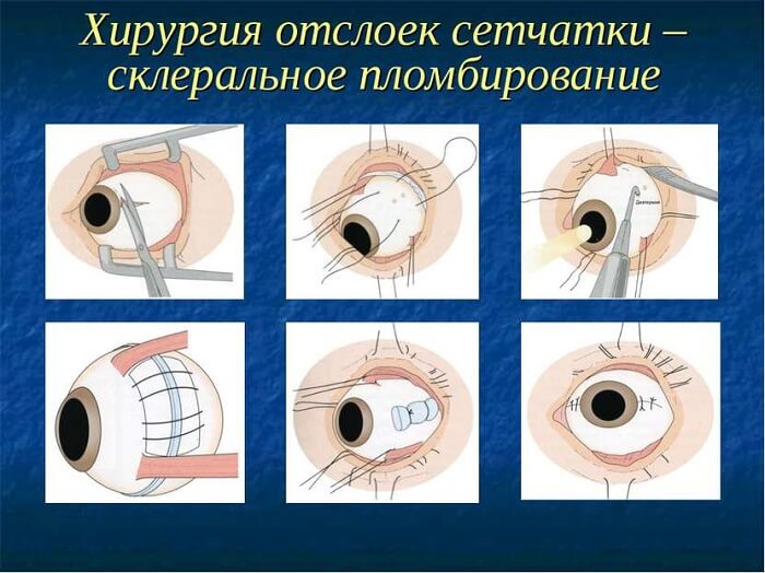 Хирургия отслойки сетчатки
