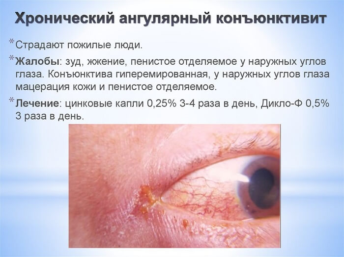 Хронический ангулярный
