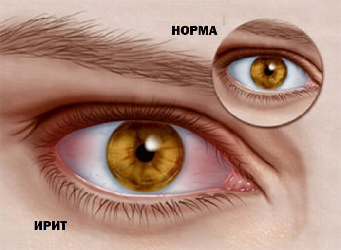 Ирит и норма у человека