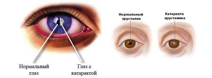 Катаракта и здоровый глаз