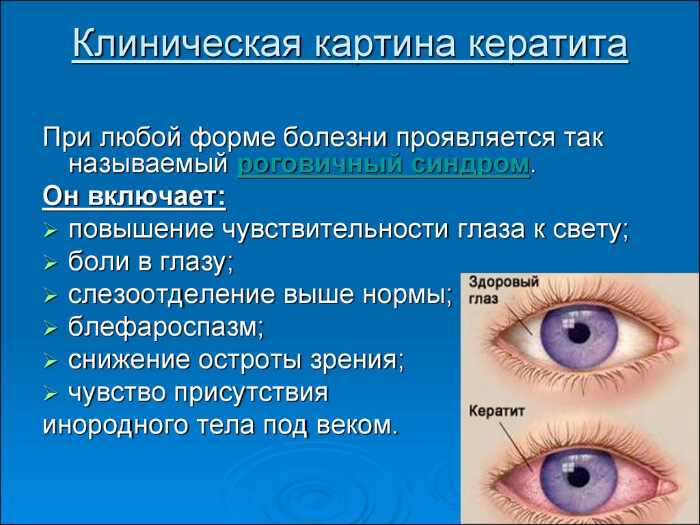 Клиническая картина кератита