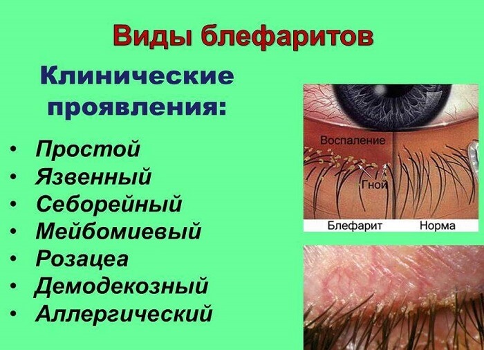 Клинические проявления блефаритов
