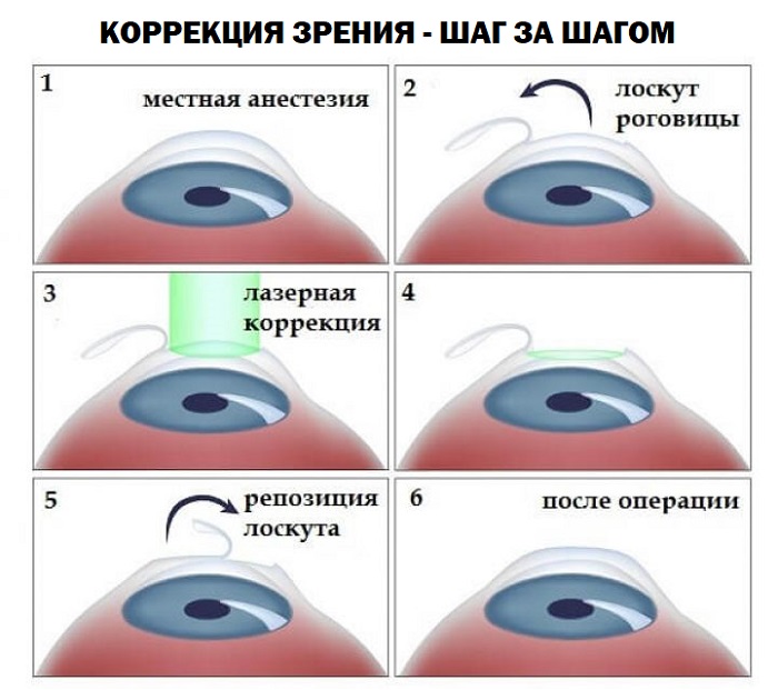 Этапы операции Коррекция зрения