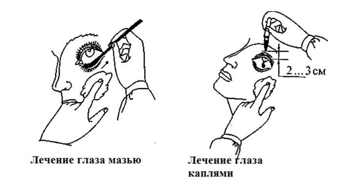 Лечение глаз