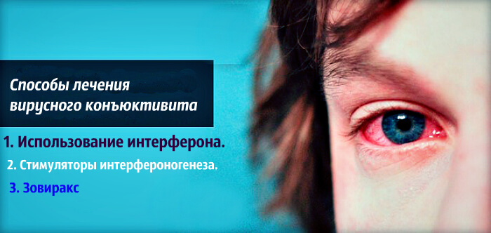 Лечение вирусного конъюктивита