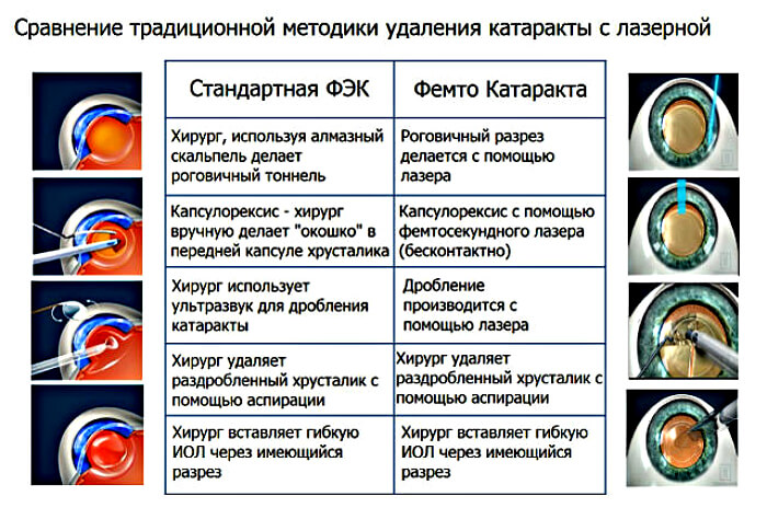 Лечение вторичной катаракты