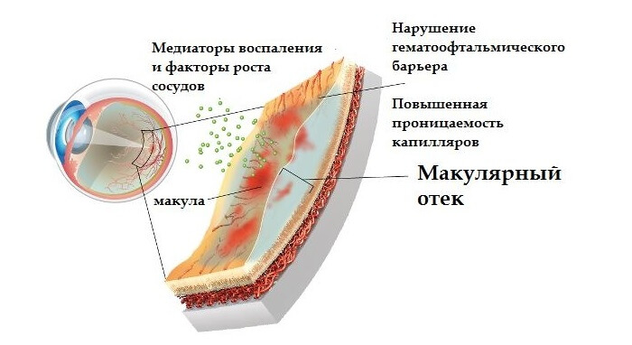 Макулярный отек глаза