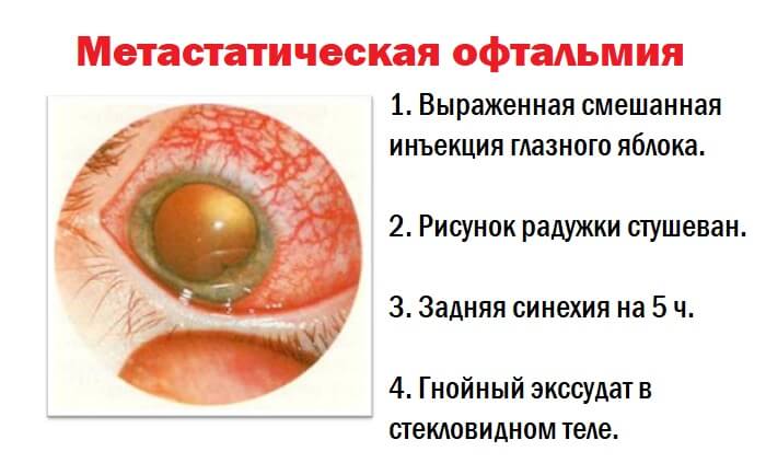 Метастатическая офтальмия глаза