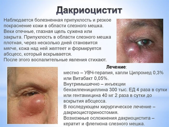 Методы лечения даокрицистита