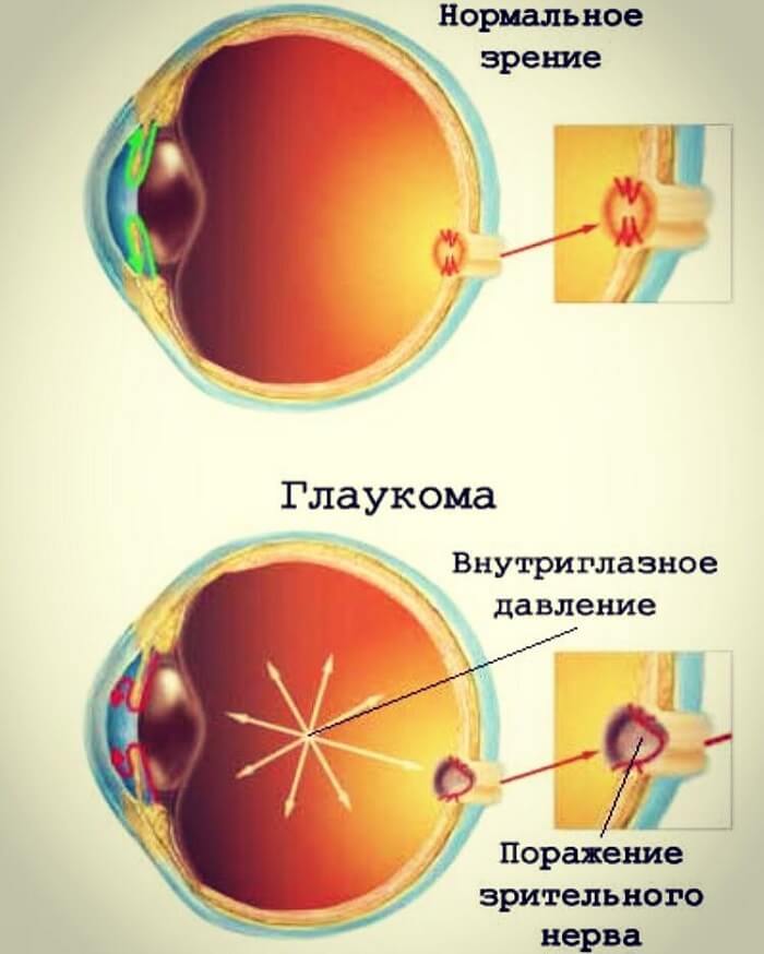 Нормальное зрение и глаукома